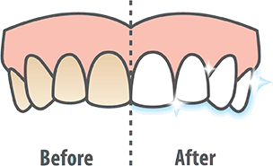 陶瓷牙齒貼片-牙齒美白服務介紹